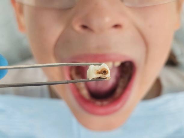 Best Dental Abscess Treatment in Kinsley, KS